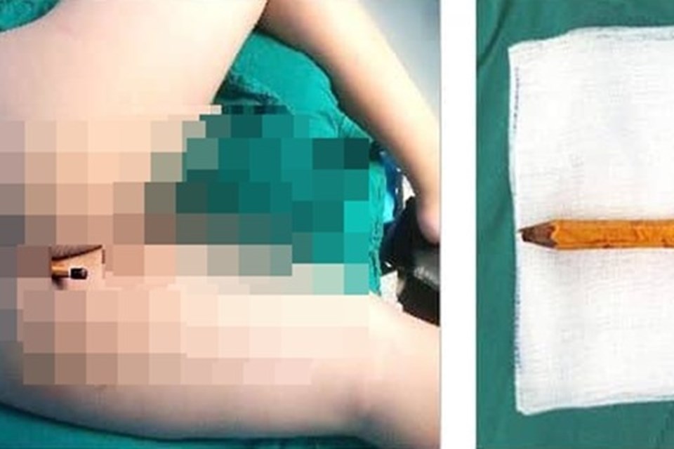 Phẫu thuật khẩn cho bé trai 9 tuổi bị bút chì đâm xuyên vào mông Phẫu thuật khẩn cho bé trai 9 tuổi bị bút chì đâm xuyên vào mông