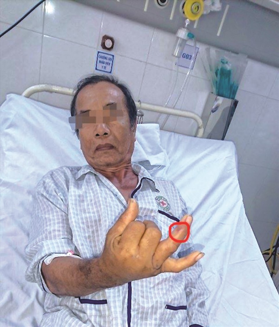 Điều trị kịp thời cho một nạn nhân bị rắn lục đuôi đỏ cắn nguy kịch. Điều trị kịp thời cho một nạn nhân bị rắn lục đuôi đỏ cắn nguy kịch.