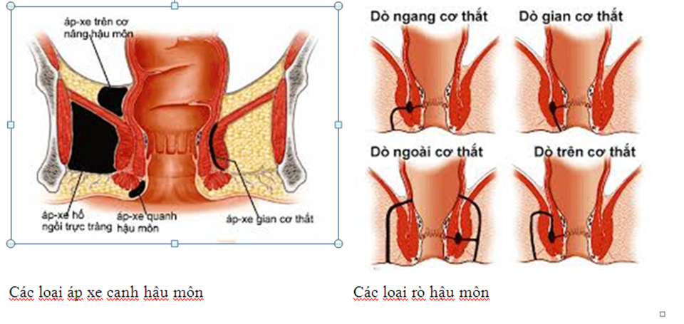Áp xe hậu môn Áp xe hậu môn