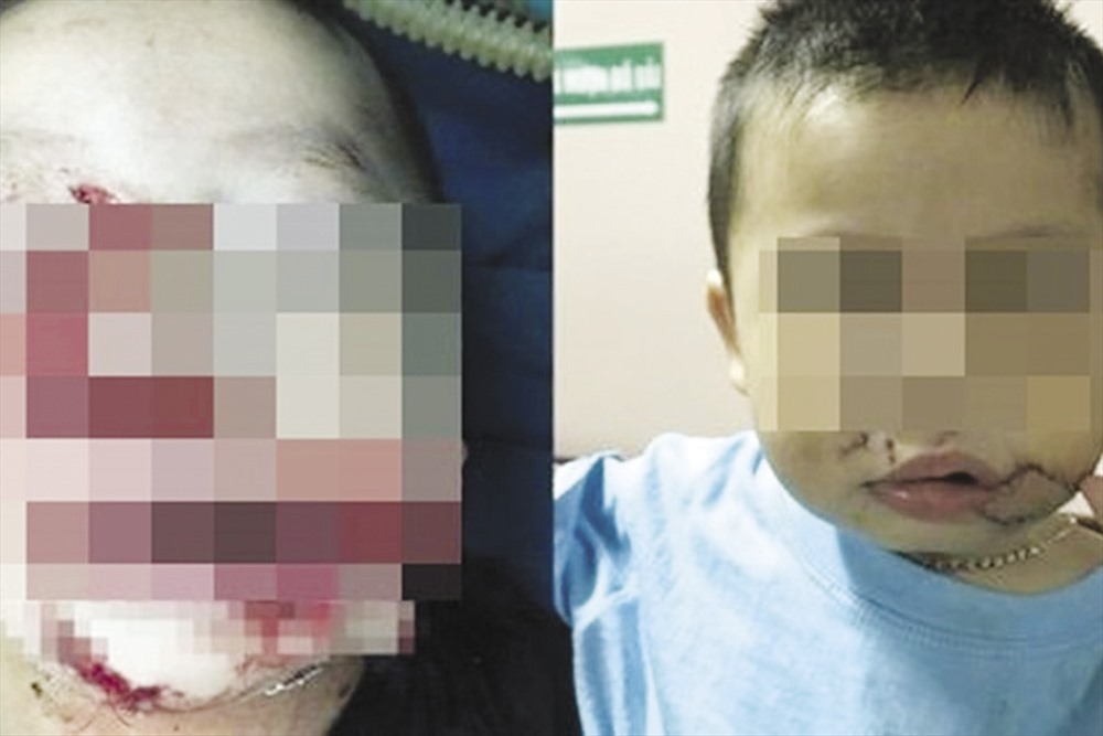 Một trường hợp bị chó nuôi cắn (ảnh trước và sau phẫu thuật).