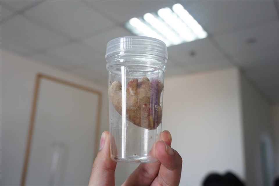 Lấy viên sỏi to như quả trứng gà ra khỏi thận của ông lão 63 tuổi Lấy viên sỏi to như quả trứng gà ra khỏi thận của ông lão 63 tuổi